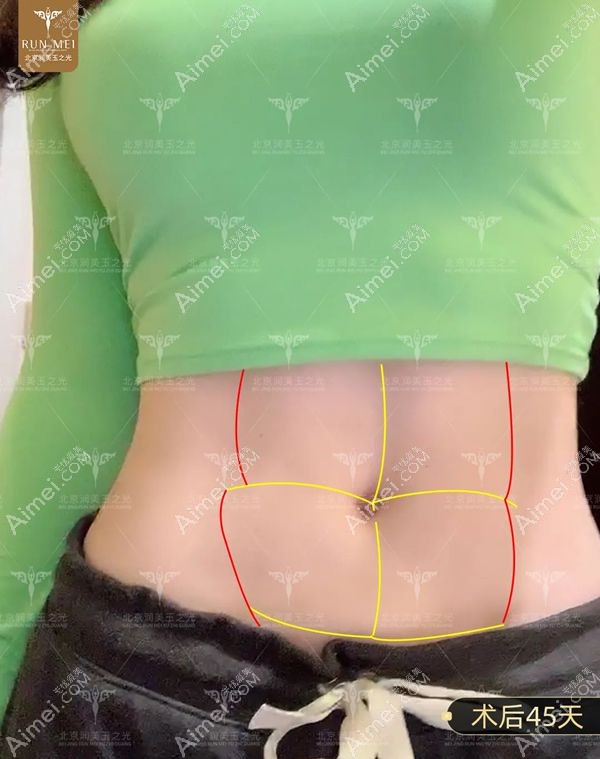 腰腹环吸术后45天腹部效果图.jpg 腰腹环吸术后45天腹部效果图.jpg