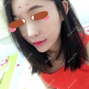 找陈鹫院长做全脸脂肪填充术后35天 找陈鹫院长做全脸脂肪填充术后35天
