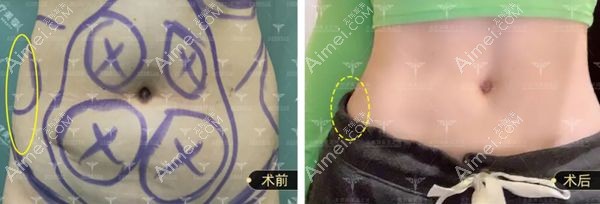 王明利院长的腰腹环吸45天案例对比图.jpg 王明利院长的腰腹环吸45天案例对比图.jpg