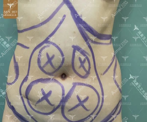 北京润美玉之光王明利设计腰腹吸脂2000cc的吸脂部位.jpg 北京润美玉之光王明利设计腰腹吸脂2000cc的吸脂部位.jpg