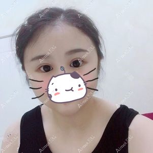 找李登进做双眼皮+开眼角术后58天 找李登进做双眼皮+开眼角术后58天