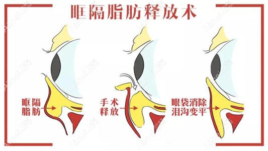 眶隔脂肪祛眼袋手术过程