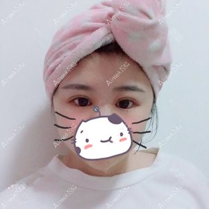 找李登进做双眼皮+开眼角术后28天 找李登进做双眼皮+开眼角术后28天