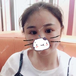 找李登进做双眼皮+开眼角术后7天 找李登进做双眼皮+开眼角术后7天