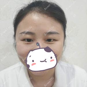 找李登进做双眼皮+开眼角术前 找李登进做双眼皮+开眼角术前