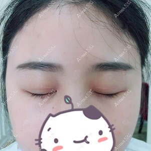 找李登进做双眼皮+开眼角术后29天 找李登进做双眼皮+开眼角术后29天