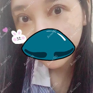 在孝感天妃做全切双眼皮修复术后7天 在孝感天妃做全切双眼皮修复术后7天