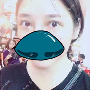 在孝感天妃做全切双眼皮修复术后15天 在孝感天妃做全切双眼皮修复术后15天