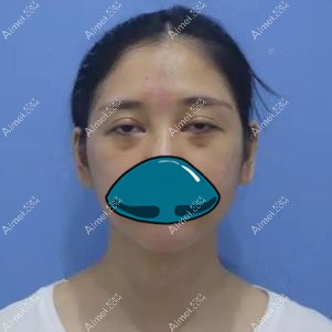 做双眼皮修复手术前照片 做双眼皮修复手术前照片