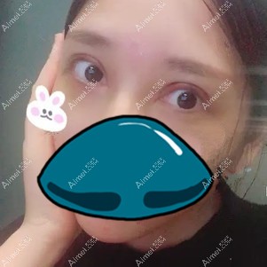 在孝感天妃做全切双眼皮术后5天 在孝感天妃做全切双眼皮术后5天