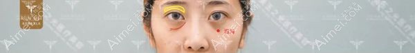 张红芳院长设计眼窝凹陷填充术前照片.jpg 张红芳院长设计眼窝凹陷填充术前照片.jpg