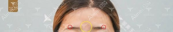 北京润美玉之光张红芳博士设计眉毛处脂肪填充.jpg 北京润美玉之光张红芳博士设计眉毛处脂肪填充.jpg