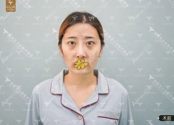 北京润美玉之光自体脂肪填充术前照片.jpg 北京润美玉之光自体脂肪填充术前照片.jpg
