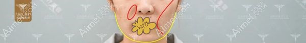 北京润美玉之光填充脸颊两侧凹陷的术前照.jpg 北京润美玉之光填充脸颊两侧凹陷的术前照.jpg