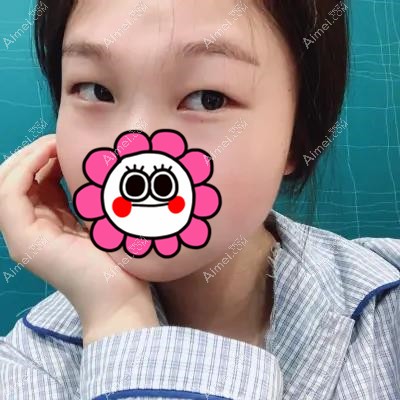 在武汉艾美做双眼皮和开眼角术前 在武汉艾美做双眼皮和开眼角术前