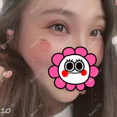 在武汉艾美做双眼皮和开眼角术后28天 在武汉艾美做双眼皮和开眼角术后28天