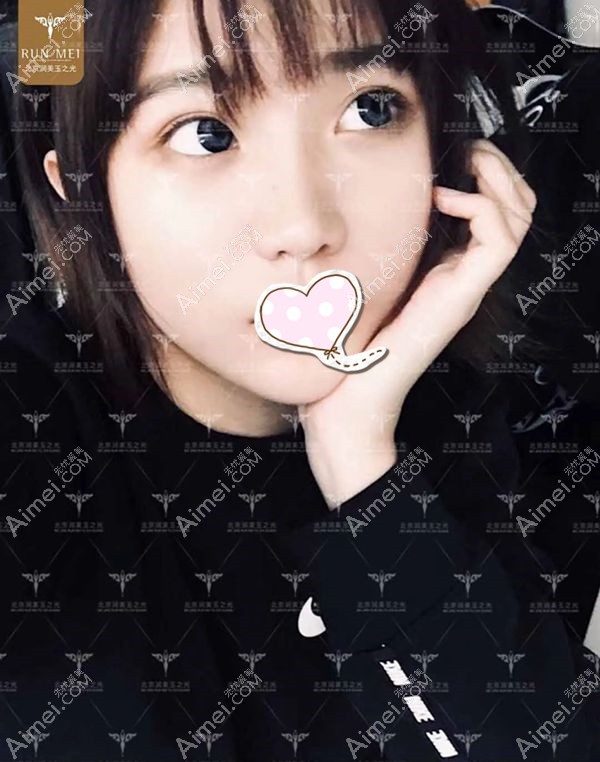 张红芳医生做的面部脂肪填充案例第12天效果.jpg 张红芳医生做的面部脂肪填充案例第12天效果.jpg