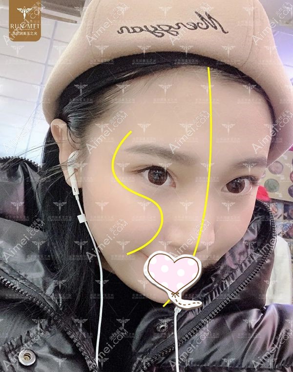张红芳医生做的面部脂肪填充案例第45天效果.jpg 张红芳医生做的面部脂肪填充案例第45天效果.jpg
