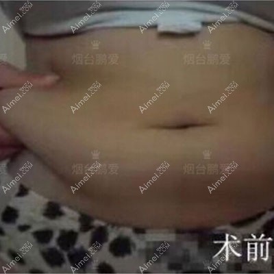 腰腹环吸术前效果图