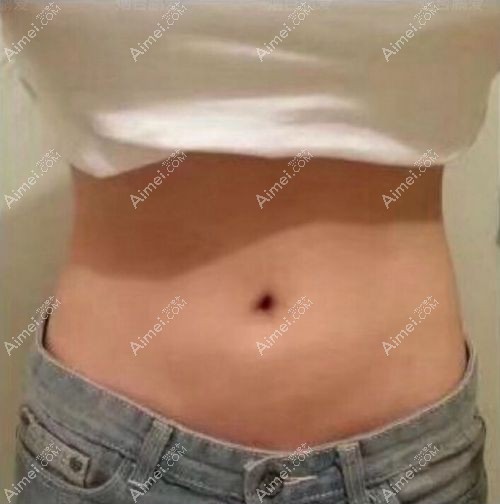 烟台鹏爱腰腹吸脂1300ml6个月后瘦4cm的效果照片.jpg 烟台鹏爱腰腹吸脂1300ml6个月后瘦4cm的效果照片.jpg