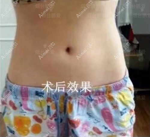 烟台鹏爱腰腹吸脂1300ml后3个月效果照片.jpg 烟台鹏爱腰腹吸脂1300ml后3个月效果照片.jpg