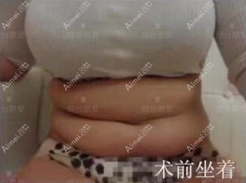 烟台鹏爱佳妍魏璐院长做的腰腹吸脂案例术前照片.jpg 烟台鹏爱佳妍魏璐院长做的腰腹吸脂案例术前照片.jpg