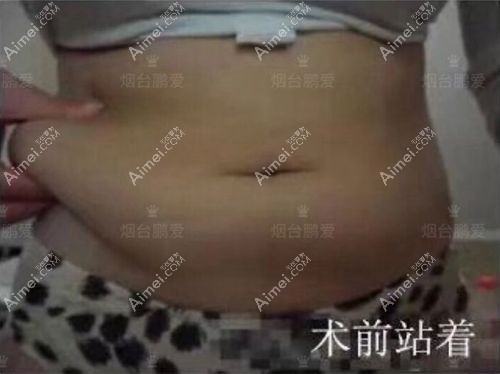 烟台鹏爱佳妍魏璐院长做的腰腹吸脂术前照片.jpg 烟台鹏爱佳妍魏璐院长做的腰腹吸脂术前照片.jpg