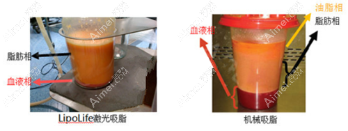 听说5G天使光雕做面部吸脂不肿，术后恢复期也很短？