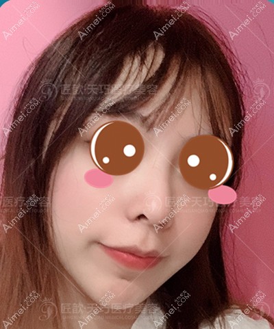 找武汉邓裴医生做肋软骨隆鼻术后43天 找武汉邓裴医生做肋软骨隆鼻术后43天