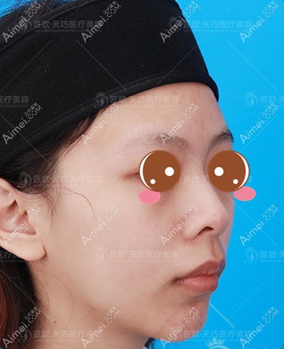 找武汉邓裴医生做肋软骨隆鼻术前 找武汉邓裴医生做肋软骨隆鼻术前