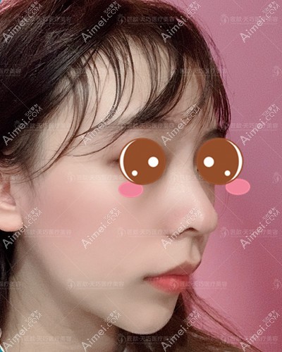 找武汉邓裴医生做肋软骨隆鼻术后3个月 找武汉邓裴医生做肋软骨隆鼻术后3个月