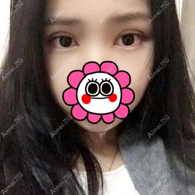 宜昌亚太做双眼皮术后4个月 宜昌亚太做双眼皮术后4个月