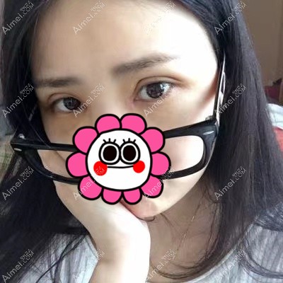 宜昌亚太做双眼皮术后7天 宜昌亚太做双眼皮术后7天