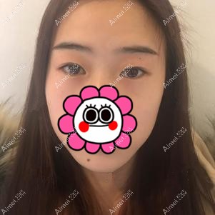 武汉卓美吴秀英做双眼皮术前