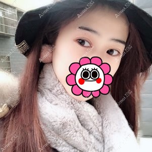 武汉卓美吴秀英做双眼皮术后26天