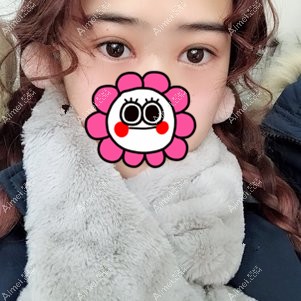武汉卓美吴秀英做双眼皮术后7天拆线