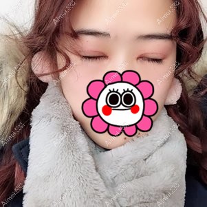 武汉卓美吴秀英做双眼皮术后7天闭眼效果