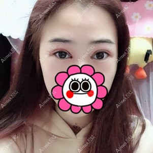武汉卓美吴秀英做双眼皮术后3天