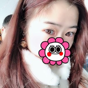 武汉卓美吴秀英做双眼皮术后15天