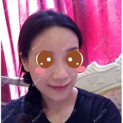 十堰梵媞注射隆鼻术后3个月 十堰梵媞注射隆鼻术后3个月