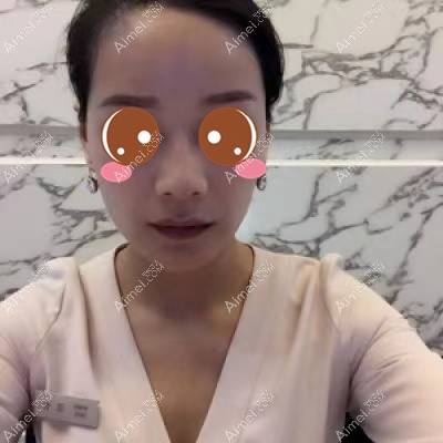 十堰梵媞玻尿酸注射隆鼻术后1个月 十堰梵媞玻尿酸注射隆鼻术后1个月