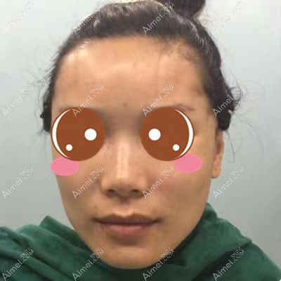 十堰梵媞注射隆鼻即刻效果 十堰梵媞注射隆鼻即刻效果