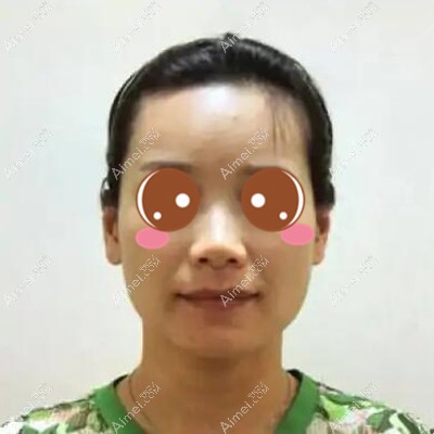 十堰梵媞注射隆鼻术前 十堰梵媞注射隆鼻术前