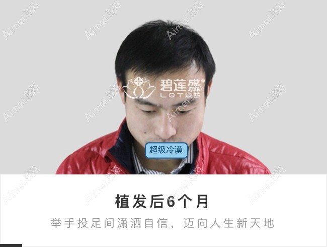 北京碧莲盛前额大面积植发6个月效果图.jpg 北京碧莲盛前额大面积植发6个月效果图.jpg