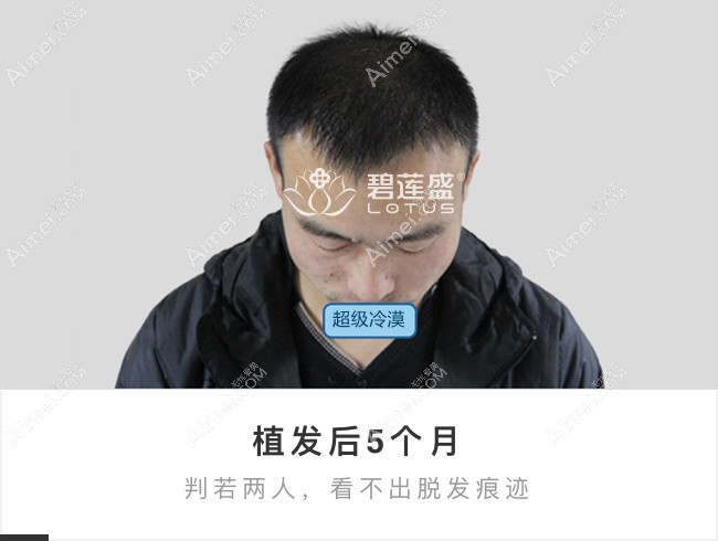 北京碧莲盛前额大面积植发5个月效果图.jpg 北京碧莲盛前额大面积植发5个月效果图.jpg