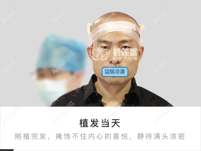 5级大面积脱发来北京碧莲盛种植4300毛囊单位.jpg 5级大面积脱发来北京碧莲盛种植4300毛囊单位.jpg