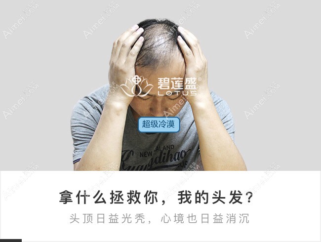 5级大面积脱发来北京碧莲盛植发手术前.jpg 5级大面积脱发来北京碧莲盛植发手术前.jpg