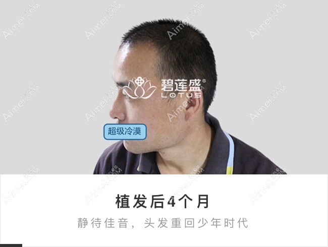 北京碧莲盛前额大面积植发4个月效果图.jpg 北京碧莲盛前额大面积植发4个月效果图.jpg