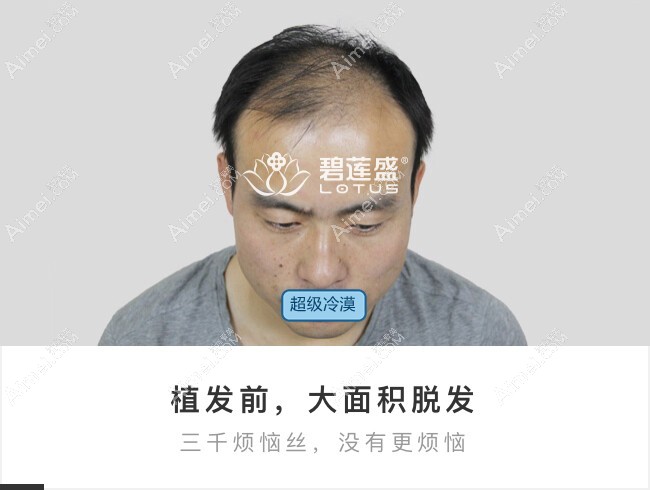 5级大面积脱发来北京碧莲盛植发术前.jpg 5级大面积脱发来北京碧莲盛植发术前.jpg