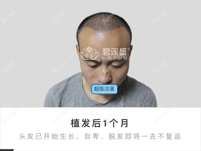 北京碧莲盛前额大面积植发1个月效果图.jpg 北京碧莲盛前额大面积植发1个月效果图.jpg